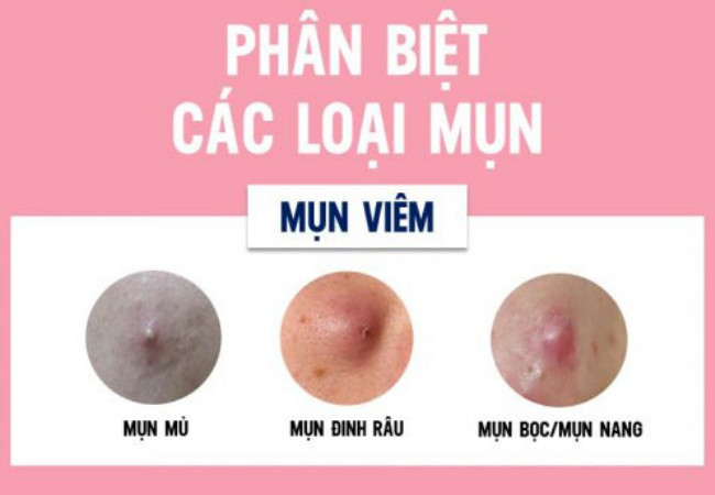 Mụn viêm và cách điều trị