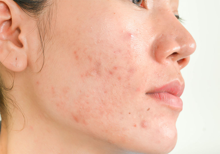 Nguyên nhân mụn dị ứng thời tiết