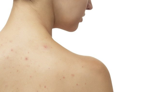 Các Vết Thâm Trên Cơ Thể Hình Thành Như Thế Nào?