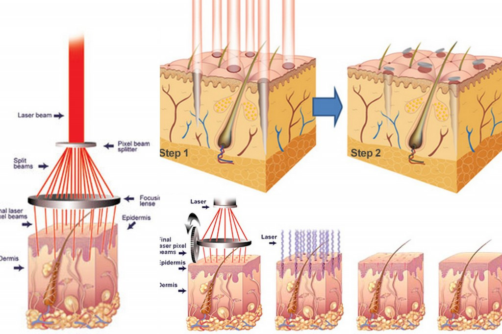 Laser điều trị sẹo lõm