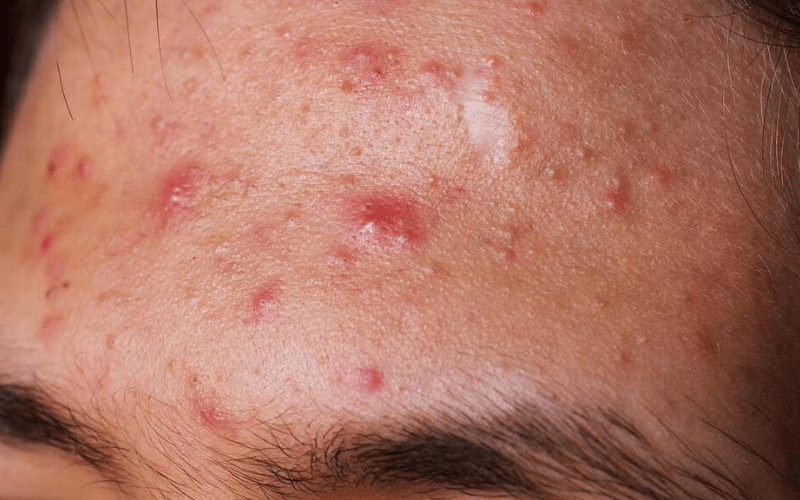 Mụn bọc trên da