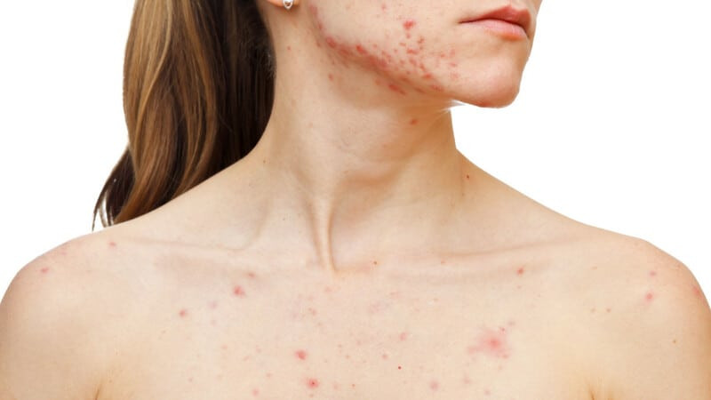 Nguyên nhân mụn ở cổ