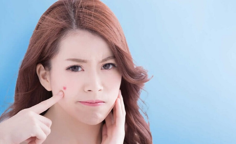 Thời gian phục hồi sau khi nặn mụn